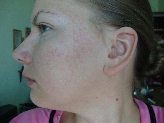 Какими бывают симптомы грибка на коже лица?