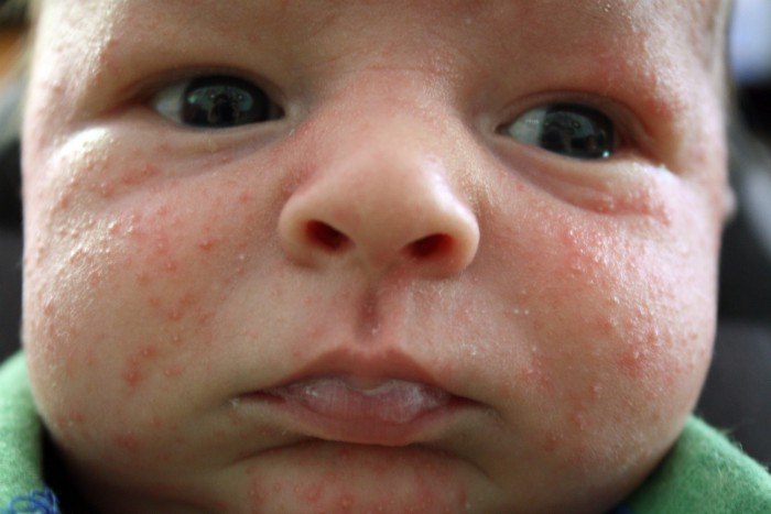 Гнойничковые поражения кожи новорожденных детей